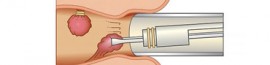 Hemoroid Hemoroid